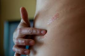 Image result for Varicella zoster on human skin