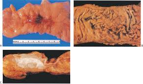 Clear cell carcinoma of the ovary. Endometriosis And Endosalpingiosis Abdominal Key