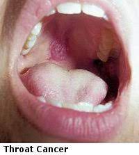 What does throat cancer feel like? Ear Nose Throat Sinus Specialists Dr Edgar Lueg Ventura Ca Head Neck Tumors