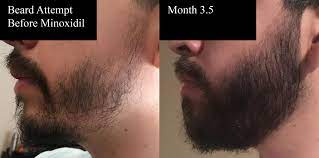 The faster you see results, the sooner you can expect to stop using minoxidil beard before and after pictures reddit. Minoxidil Beard