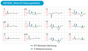 1 year outcomes in acute myocardial infarction as defined by the esc/acc definition (the opera registry). Klassifikation Von Akuten Koronarsyndromen Acs Und Akutem Myokardinfarkt Ami Ekg Echo