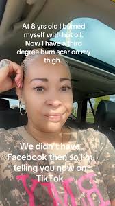 Overcoming Childhood Burn Scars: A True Story