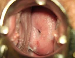 Image result for Friable Cervix