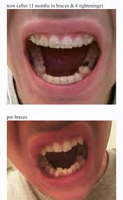 Do I Need Braces? | 5 Signs You Need Braces