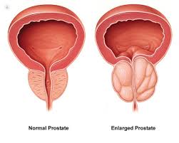 19:47 edt, 27 august 2021 | updated: Everything You Need To Know About Prostate Cancer