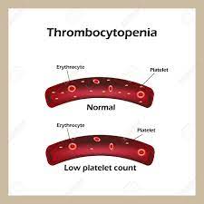 Thrombocytopenia means you have fewer than 150,000 platelets per microliter of circulating blood. La Trombocitopenia Los Niveles Reducidos De Plaquetas En La Sangre Infografia Ilustracion Del Vector Ilustraciones Vectoriales Clip Art Vectorizado Libre De Derechos Image 50243552