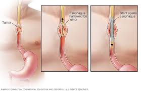 To see other pages, use the menu. Esophageal Cancer Diagnosis And Treatment Mayo Clinic