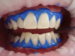 Dental sealants were first introduced to the general population in the 1960s as a way to prevent initial caries in young children and young adults.1 according to the ada, sealants on permanent molars. Dental Sealants Pearls Of Dentistry