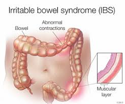 Do not accept a diagnosis of ibs without a thorough check for bowel cancer. Managing Irritable Bowel Syndrome Mayo Clinic Health System