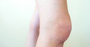 Knee Swelling Symptoms Causes Treatments