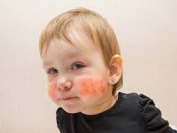 Image result for dermatitis contacta children