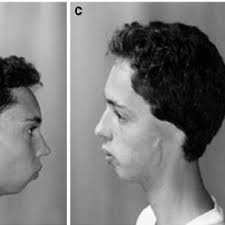 Clinical aspects of the face and upper limbs of patient 1.