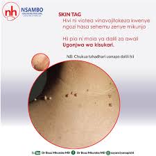 Je Wajua SKIN TAGS ni Dalili Mojawapo...
