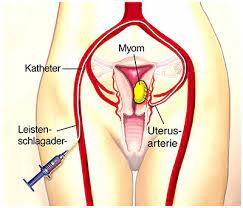 Das verfahren gehört noch nicht zur standardtherapie und wird erst in wenigen kliniken getestet. Uterusmyom Ursachen Symptome Behandlung Medlexi De