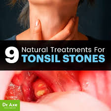 Common methods a healthcare provider may use to remove tonsil stones include irrigation with saline, curettage (using a curette to scoop the stone out), or expressing the stone out manually with a sterile swab. Tonsil Stones Causes Symptoms And Treatment Options Dr Axe