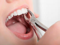 Teeth extraction in Wagholi, Pune product image