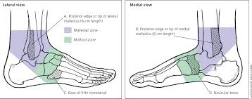 Here you find 4 meanings of the word malleolus. Diagnosis And Management Of Common Foot Fractures American Family Physician