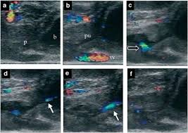 How to fix retrograde ejaculation biggerdanme i had laser surgery on my urinary tract suffer from retrograde ejaculation was not informed that this would happen before the procedure what can be done to restore normal ejaculation is there any legal action i can take or medical restoration. Analysis Of Retrograde Ejaculation Using Color Doppler Ultrasonography Before And After Transurethral Collagen Injection International Journal Of Impotence Research