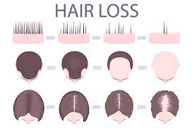 Read the blog to find out the symptoms, reasons, effective solution to prevent hair fall in both men and women naturally. Hair Loss Who Gets And Causes