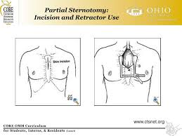 The scary incident left pat with multiple ruptured discs in her back. Ppt Ribs Post Sternotomy Pain Powerpoint Presentation Free Download Id 6638318