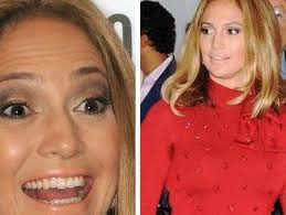 Svitakirtlar Jennifer Lopez áhyggjuefni