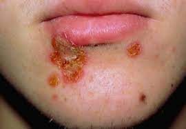 Bakterien der art staphylococcus aureus kommen auf der haut und den schleimhäuten von vielen gesunden menschen vor. Kutane Infektionen Durch Staphylokokken Und Streptokokken Springerlink
