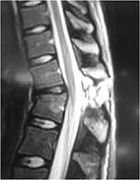 Communications services form the backbone of the wan. Types Of Spinal Fractures