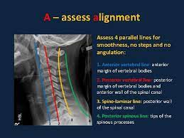 Line from base of skull to hard palate. Part 4 0 Standardised Interpretation Of Paediatric Cervical