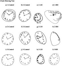 You can edit any of drawings via our online image editor before downloading. Clock Drawing In Children With Perinatal Stroke Sciencedirect