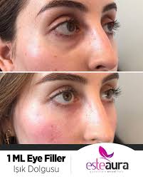 Eye Filler Under Eye Filler 2020 Estetik