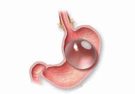 Orbera Balloon (Gastric Balloon) in Brisbane | Safe, Non-Surgical Weight Loss | Weight Loss Surgery Brisbane | Brisbane Obesity Clinic