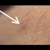 Deep ingrown hair is when the hair follicle curls deeper in the skin and start growing deeper inwards instead of out the skin. 1