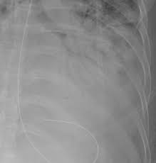 Image result for Air Bronchogram