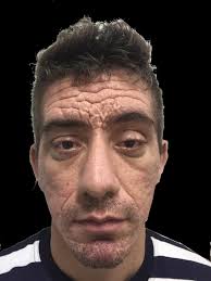 Frontal lifting using a tissue expander in pachydermoperiostosis: A case  report