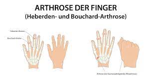 Eine arthrose der finger verläuft manchmal aber auch schmerzfrei ohne ernsthafte beeinträchtigung. Was Ist Eine Heberden Arthrose
