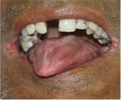 In case of significant obstruction of the esophageal lumen by esophageal web and persistent dysphagia despite iron supplementation, rupture and dilation of the web are necessary. Plummer Vinson Syndrome A Rare Syndrome In Male With Review Of The Literature
