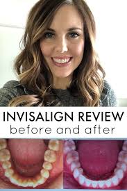 Before And After Invisalign Reveal Review With Defay Orthodontics Six Sisters Stuff Invisalign Orthodontics Teeth Care