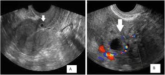 Only the uterus can hold a growing embryo, so in these other cases, the pregnancy cannot progress. Non Tubal Ectopic Pregnancy Diagnosis And Management Intechopen