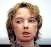 First Face Transplant Patient, A French Woman, Dies