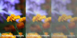 Retinal detachment is an eye problem that happens when your retina is pulled away from its normal position. Three Things To Know About Cataracts Florida Eye Institute