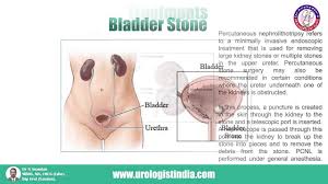 Read Blogs Dr N Anandans Urology Clinic Best Urologist In Chennai