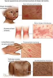 Image Description Not Available Atopic Dermatitis Dermatology Nurse Medical Knowledge