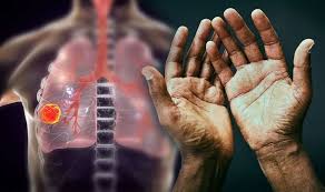 Because there are very few nerve endings in the lungs, a tumor could grow without causing pain or discomfort. Lung Cancer Having An Unusual Change In Your Fingers And Nails Could Mean You Are At Risk Express Co Uk