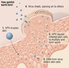 Image result for genital warts