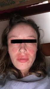 What's in Redlands water causing skin issues?