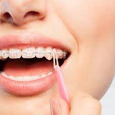 Wear them full time and you'll see an amazing result. Why Are Elastics Used In Braces Treatment Peak Orthodontics