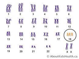 Edwards syndrome, also known as trisomy 18, is a genetic disorder caused by the presence of a third copy of all or part of chromosome 18. Trisomy 18 Edwards Syndrome