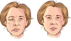 Check spelling or type a new query. Facial Paralysis Houston Bell S Palsy The Woodlands