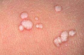 How a wart is treated depends on the type of wart, its location, and its symptoms. What Is The Most Cost Effective Treatment For Genital Warts The Answer May Surprise You Jail Medicine