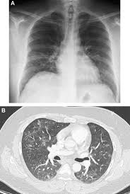 © gouvernement du québec, 2015. Manifestations Pulmonaires Au Cours De L Infection Par Le Vih Demarche Diagnostique Sciencedirect